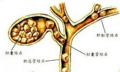 膽結(jié)石要做哪些檢查