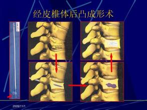 骨科特色療法——椎體成形術(shù)