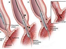 消化內(nèi)科科室特色--內(nèi)鏡下食管狹窄擴張術(shù)
