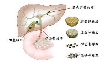 膽道切開取石術