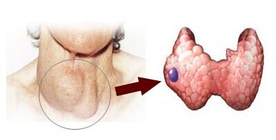 頸部小切口微創(chuàng)甲狀腺瘤切除術