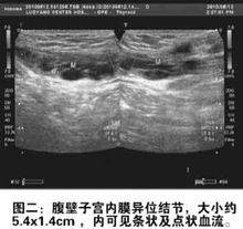 腹壁子宮內(nèi)膜異位癥